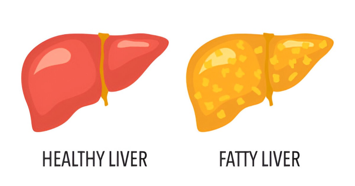 healthy and fatty liver