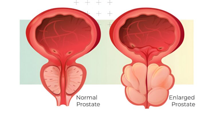 प्रोस्टेट क्यों बढ़ता है? जान लें इसका कारण, निदान और उपचार