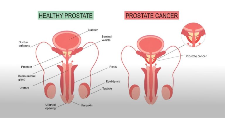 प्रोस्टेट कैंसर: चेतावनी संकेत, कारण और इलाज