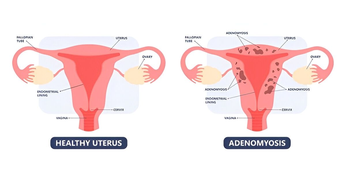 एडिनोमायोसिस adenomyosis