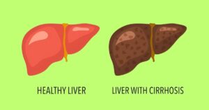 लीवर सिरोसिस: लक्षण, कारण, टेस्ट और इलाज