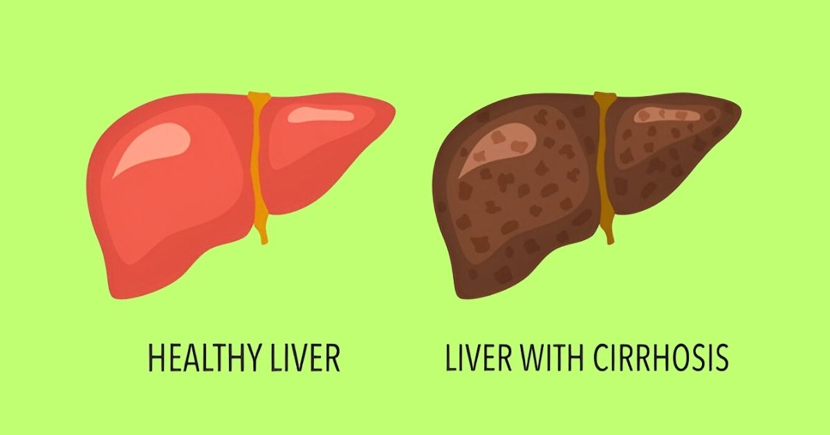 Liver Cirrhosis